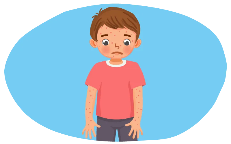 chickenpox symptoms