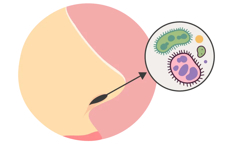 HiB bacteria in nose