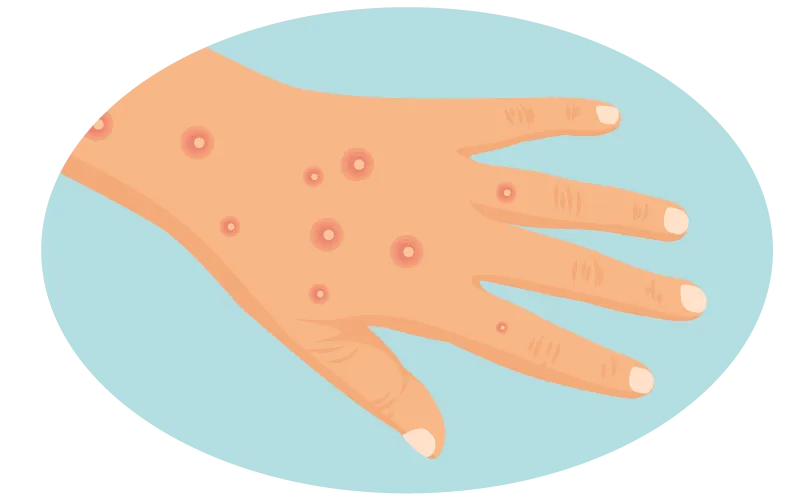 Mpox hand blisters