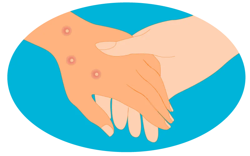 How is Mpox spread
