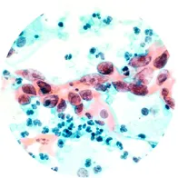 hpv infection