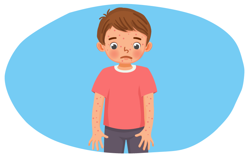 chickenpox symptoms