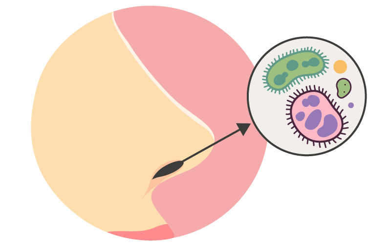 HiB bacteria in nose