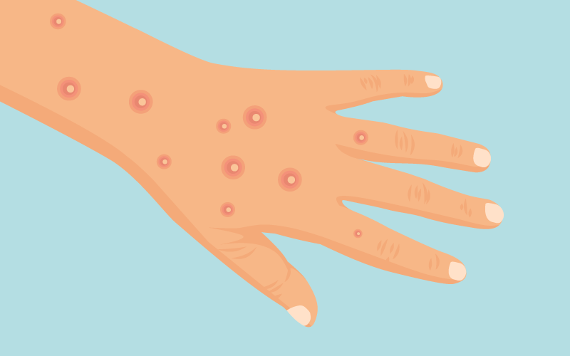 Symptoms of Mpox