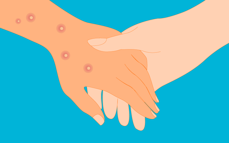 Mpox spreads through physical contact